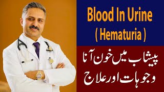 Blood in Urine  Hematuria  Causes amp Treatment [upl. by Nosidam]