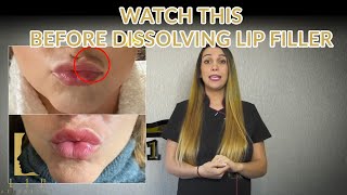 This You Should Know Before Dissolving Lip Filler  L1P AESTHETICS [upl. by Horodko]