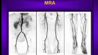 Coronary Arteries  Anatomy Tutorial [upl. by Tacklind144]