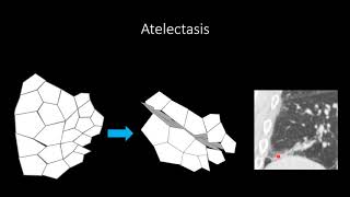 Atelectasis [upl. by Aitrop]