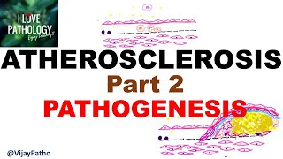 ATHEROSCLEROSIS  Part 2 Pathogenesis [upl. by Hanima562]