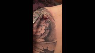 Infected abscess on tattoo [upl. by Nickolas]