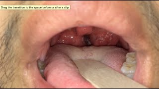 How Do I Recognize a Sore Throat from an STD [upl. by Onitram]