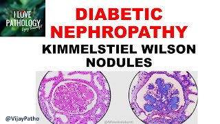 DIABETIC NEPHROPATHY Pathophysiology amp Morphology [upl. by Olly]