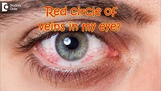 How do I get rid of the orangered circle of veins in my eye  Dr Sriram Ramalingam [upl. by Sama]