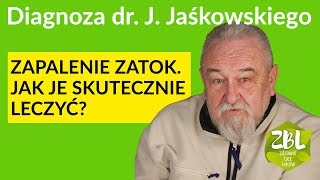 dr Jerzy Jaśkowski  Leczenie zapalenia zatok [upl. by Anirba602]