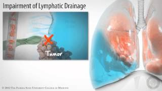 Pleural Space Part 3 of 3 Pleural Effusions HD [upl. by Arissa]