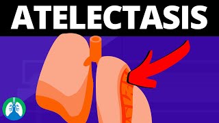 Atelectasis Medical Definition  Quick Explainer Video [upl. by Atikam]