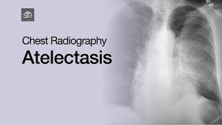 Chest Radiography Atelectasis [upl. by Aicilram]