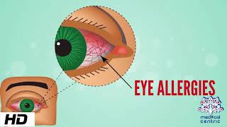 Eye Allergy Causes Signs and Symptoms Diagnosis and Treatment [upl. by Natie]