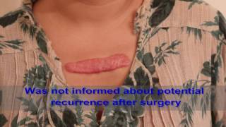 Chest Keloids  Mistakes to Avoid [upl. by Cantone806]