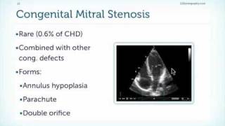 Mitral Stenosis Basics [upl. by Abie]