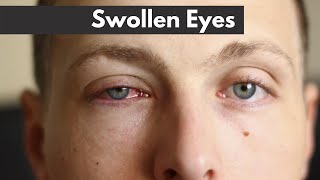 Swollen eyes  EXPLAINED  Dr DOrio Eyecare [upl. by Dyraj]