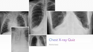 Chest Xray Quiz Atelectasis [upl. by Austen]