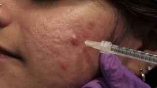 Watch amp Learn Intralesional injections [upl. by Usanis]