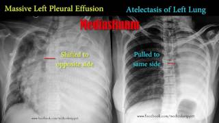 pleural effusion vs atelectasis [upl. by Haym]