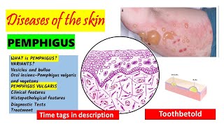 Pemphigus Vulgaris  HISTOPATHOLOGY  Immunofluorescence  Treatment  PART 22 [upl. by Py]