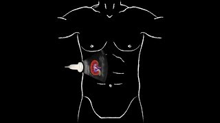 POCUS  Basic Renal Ultrasound [upl. by Casaleggio]