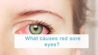 What causes red sore eyes [upl. by Spindell]