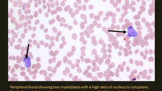 Pediatric Leukemia and lymphoma [upl. by Aleacem]