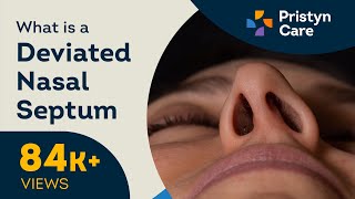 What is a Deviated Nasal Septum  Treatment for DNS [upl. by Nawram]