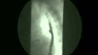 Video 8  Gastroesophageal reflux [upl. by Nodnorb742]