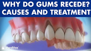 Gum recession  Treatment of gingival retraction © [upl. by Jessie484]