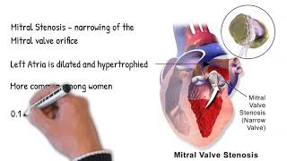 Mitral valve stenosis  symptoms causes treatment [upl. by Therron]