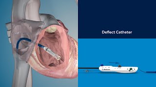 Micra TPS Implant Procedure Animation [upl. by Erda205]