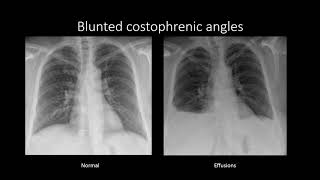 Pleural Effusions [upl. by Woodhouse]