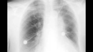 Left Upper Lobe Atelectasis on Chest X ray [upl. by Anagrom276]