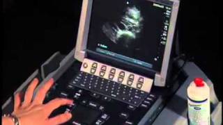 How To Abdominal Ultrasound  Aorta Measurements [upl. by Reggie532]