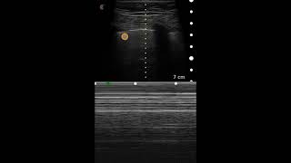 Pneumothorax Ultrasound Image Interpretation [upl. by Annahael34]