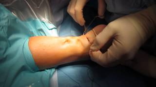 Percutaneous Achilles Tendon Surgery Repair Unedited by Kevin R Stone MD [upl. by Eldred]