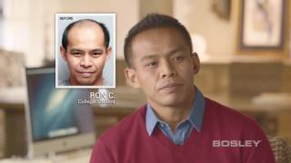 Bosley Hair Transplant Patient Review  Ron C [upl. by Atilol134]