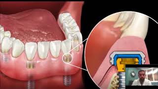 Dental Implant Overdenture  SnapIn Dentures [upl. by Noryd]