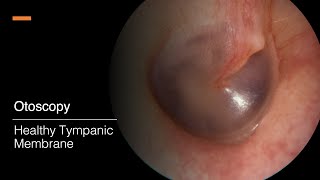 Tympanic Membrane Otosopy [upl. by Amsa]