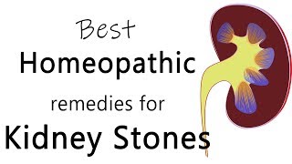 Best homeopathic medicine for stone in kidney  Dr Sanjay Panicker [upl. by Ramas]