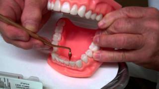 Rubber Tip Stimulator  Oral Hygiene Instructions by Dr Berdy periodontist Jacksonville FL [upl. by Angadreme]