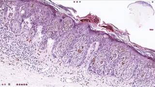 Compound Melanocytic Nevus  Histopathology [upl. by Yrailih576]