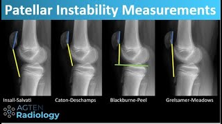 Patellar Instability  What and How to Measure [upl. by Narba]