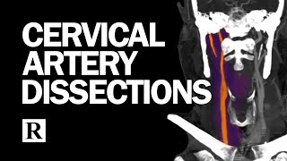 Cervical Arterial Dissections [upl. by Adnawak556]