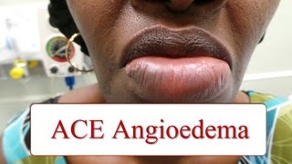 Lip Filler Migration Causes amp Prevention [upl. by Berkly]