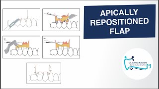 APICALLY REPOSITIONED FLAP PERIODONTAL FLAP SURGICAL TECHNIQUE DR ANKITA KOTECHA [upl. by Udale]