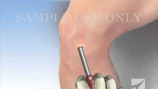 Knee Arthroscopy [upl. by Clercq385]