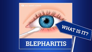 Blepharitis red swollen eyelids Causes Symptoms Treatments [upl. by Phaih]