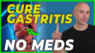 HOW to CURE GASTRITIS without medications  DR CARLOS [upl. by Isbella]