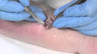 How to Suture  part 4 the Z plasty [upl. by Alesig]