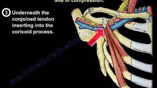 Thoracic Outlet Syndrome  Everything You Need To Know  Dr Nabil Ebraheim [upl. by Caressa]