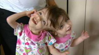 Conjoined Twins Twin Girls A Medical Wonder [upl. by Mosera]